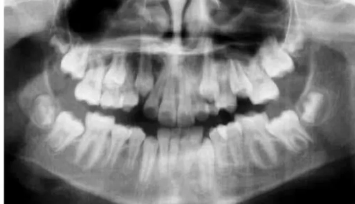Figure 5 - Intermediate lateral cephalometric radiograph and tracing. Figure 6 - Intermediate panoramic radiograph.