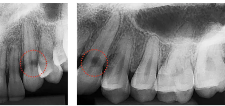 Figure 3. External Cervical Resorption in left maxillary canine (circle) revealed by periapical radiograph