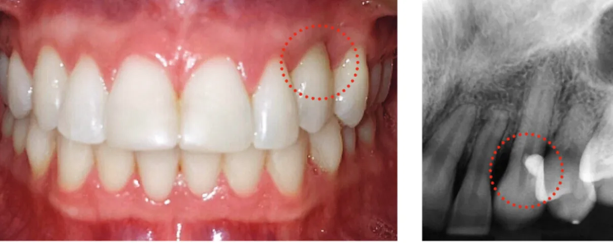 Figure 6. Dental and gingival condition of patient with External Cervical Resorption in left maxillary canine (circle) three months after  restorative treatment onset.