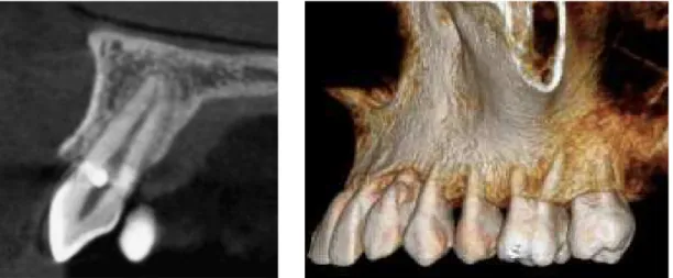 Figure 7. Sagittal tomographic slice and 3D CT scan of External Cervical Resorption in left maxillary canine (circle) three months after  restorative treatment onset.