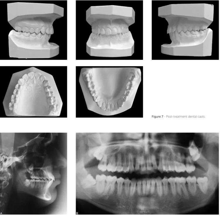 Figure 7 - Post-treatment dental casts.