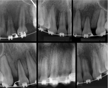 Figure 1 - Periapical radiograph of patients comprising the mild to moder- moder-ate IERR group.