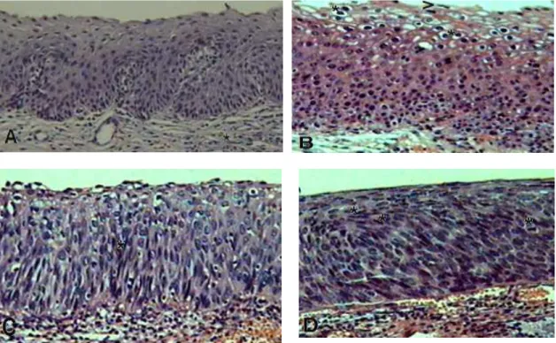 Figura 2. Histologia de amostras representativas. A. Cervicite: Epitélio estratificado escamoso não ceratinizado