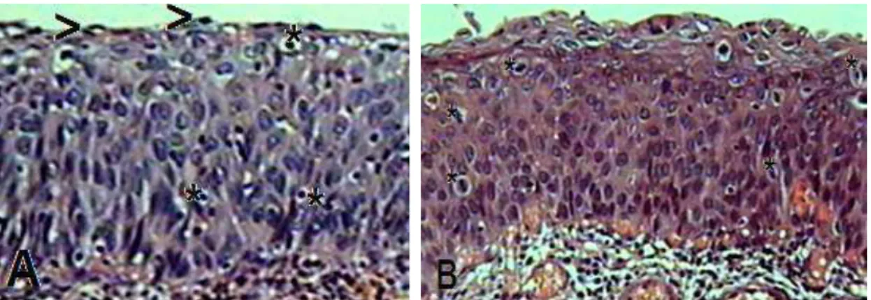 Figura 3. Apoptose. A.anoiquia, condensação (*) e fragmentação nuclear, formação de corpos apoptóticos (ponta  de seta,&gt;)