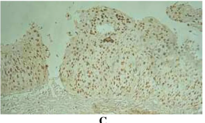 Figura  4:  Expressão  da  imunomarcação  pelo  Ki-67.  A-  Cervicite:  reatividade  baixa,  intensidade  fraca  e  localização  nas  células  do  extrato  basal  do  epitélio  escamoso
