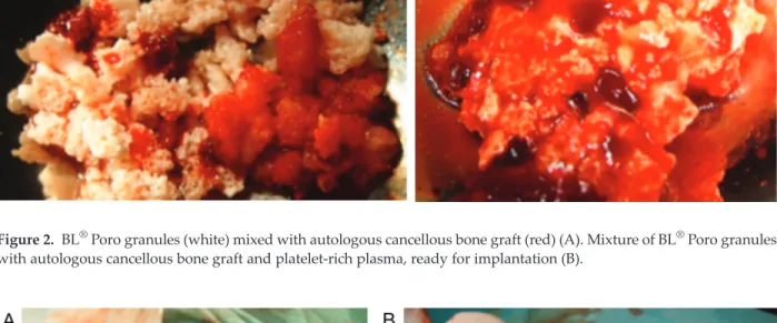 Figure 2. BL ® Poro granules (white) mixed with autologous cancellous bone graft (red) (A)