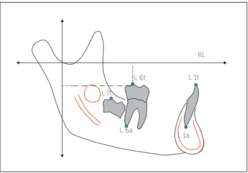 Figure 1 - Occlusal view of pre-fabricated lip bumpers with an acrylic shield  extending from canine to canine and fitted on molar tubes.