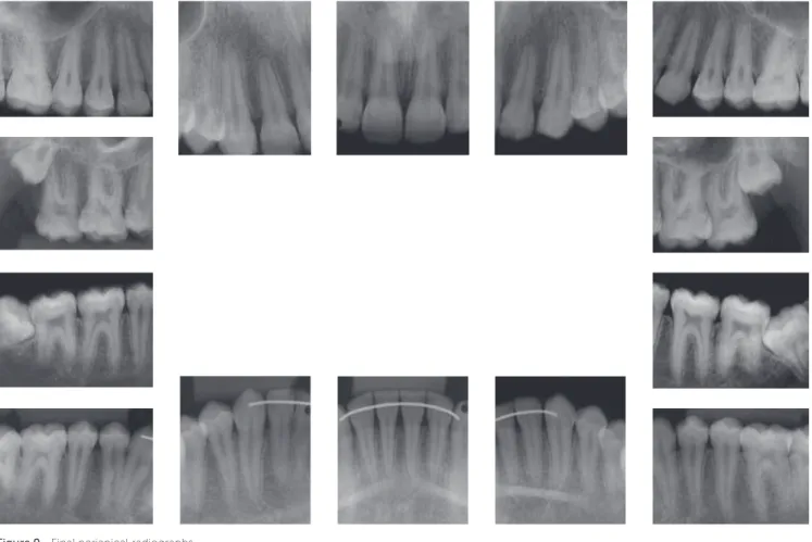 Figure 9 - Final periapical radiographs.