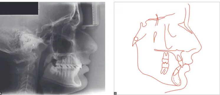 Figure 11 - Final lateral cephalogram (A) and cephalometric tracing (B).