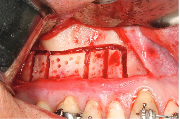 Figure 1 - Corticotomy. Mucoperiosteal flaps are raised and corticotomy carried out on buccal and palatal surfaces