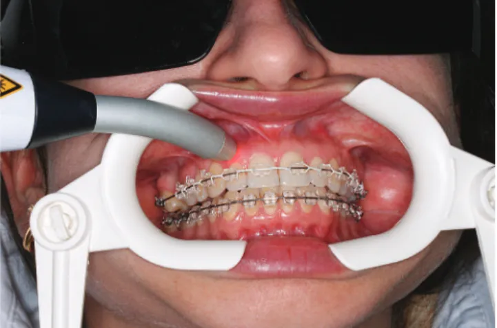 Figure 2 - Laser irradiation. Application of LLLT in areas of intended tooth  movement.