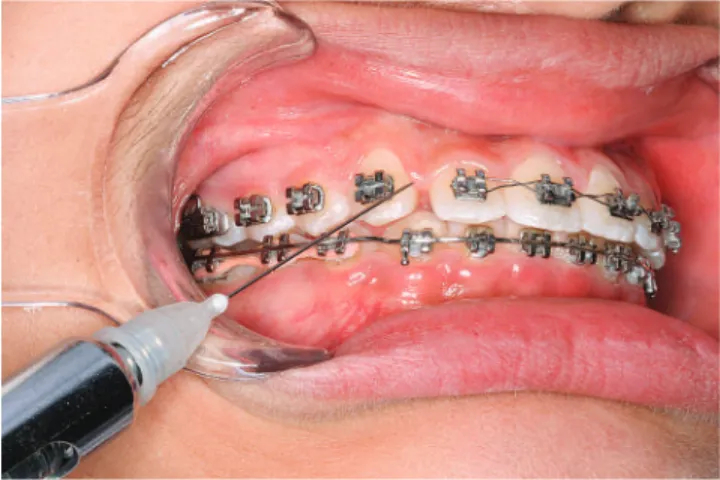 Figure 4 - Injection of biomodulators. Injection of inflammatory mediators  in the periodontium.