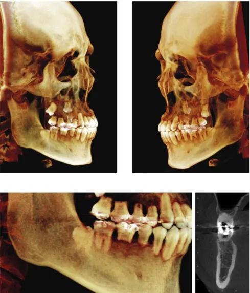 Figure 4. Severe inflammatory root resorption  (Malmgren’s grade 4) revealed by 3D tomographic  scans that allow a contextual and comparative  as-sessment of the process in each tooth and their  respective surfaces.