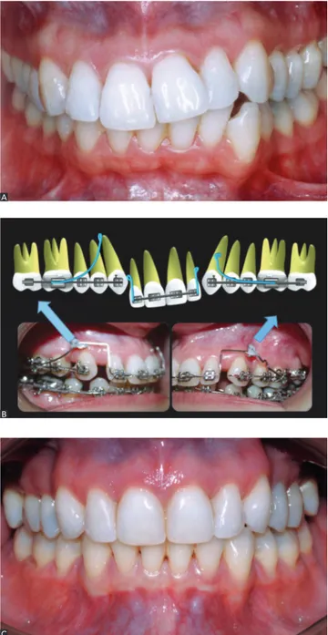 Figure 10 - A) Clinical case in need of correction of the occlusal plane in  the incisors area