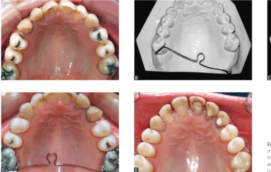 Figure 1 - A) Clinical case revealing totally tipped  molars. B, C) Dental casts revealing activation of  transpalatal arch in VI geometry