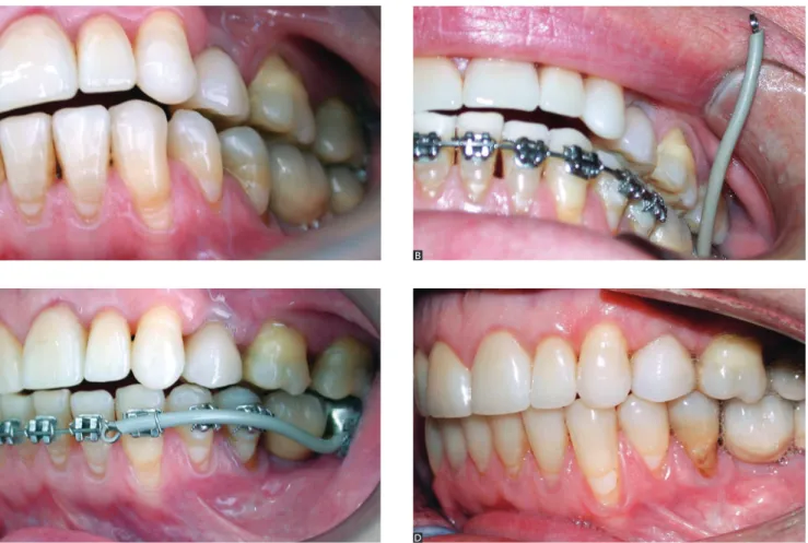 Figure 2 - Clinical case using cantilever and implant anchorage with Straight-Wire brackets to correct open bite and asymmetry to the left.