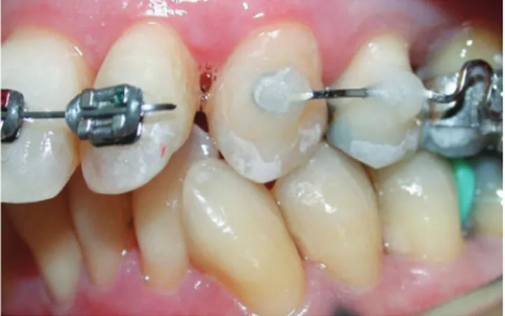 Figure 3 - Anchorage with wire bonded directly to teeth.