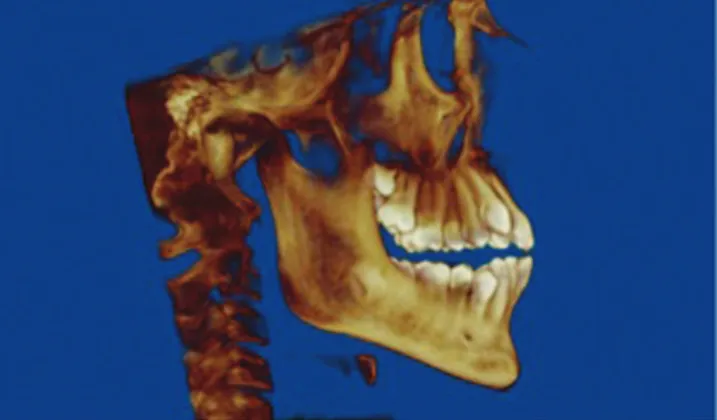 Figure 3 - Custom focal trough selection for panoramic reconstruction  from CBCT.