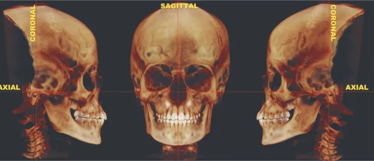 Figure 2 - Three-dimensional image of the head after standardization by axial, coronal and sagittal reference planes