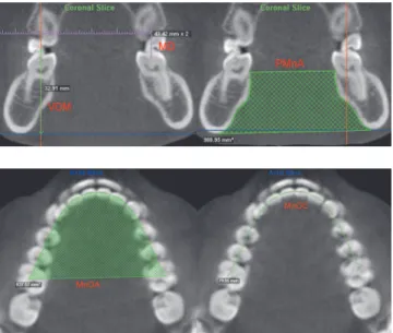 Figure 2 - Maxillary measures: (MD) intermolar distance; (VDM) vertical displacement of molars and (PMA) posterior maxillary cross-sectional area