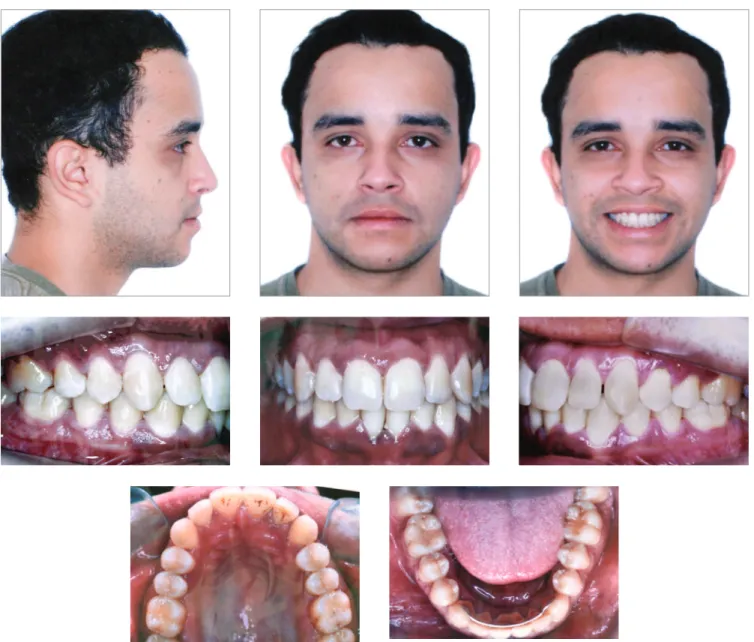 Figure 13 - Control facial intraoral photographs 10 years after treatment completion.