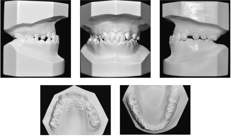 Figure 2 - Initial casts.