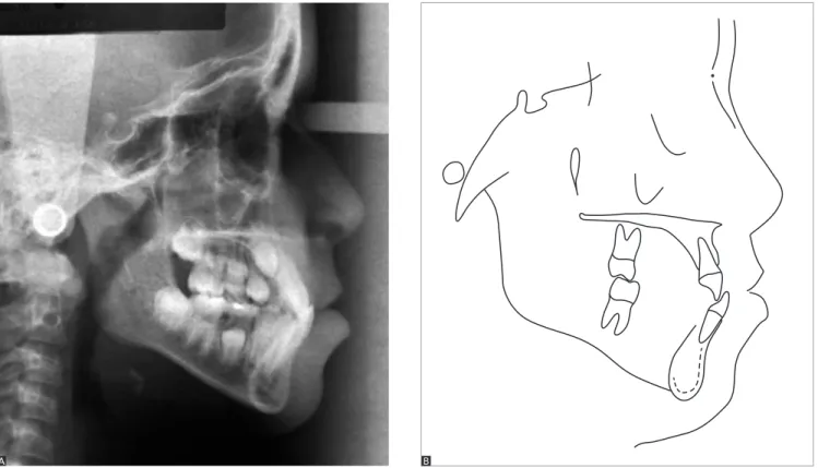 Figure 4 - Initial lateral cephalogram (A) and cephalometric tracing (B).