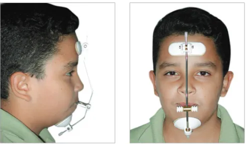 Figure 6 - Petit face mask with 600-g force applied.