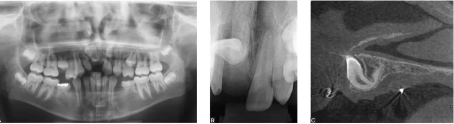 Figure 5 - Retention of right maxillary central incisor caused by trauma during childhood