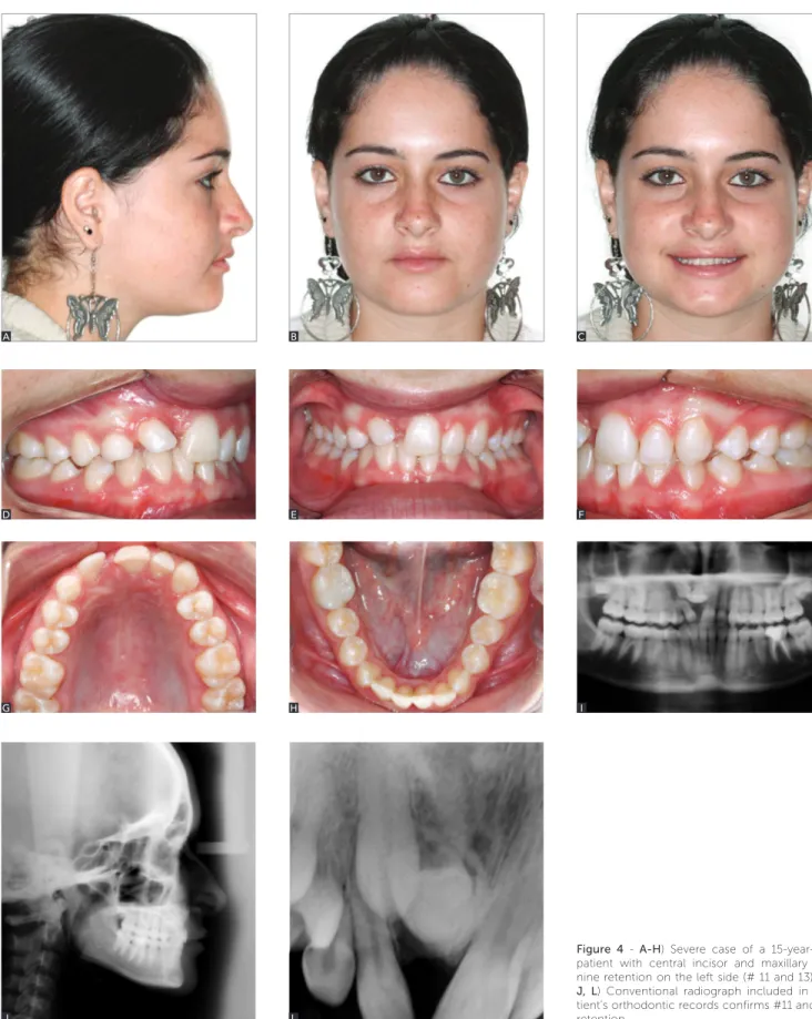 Figure 4 - A-H)  Severe case of a 15-year-old  patient with central incisor and maxillary  ca-nine retention on the left side (# 11 and 13)