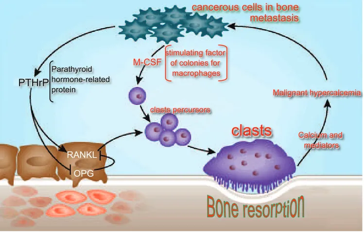 Figure 1. Neoplastic malignant cells release mediators that ease their dissemination in the skeleton