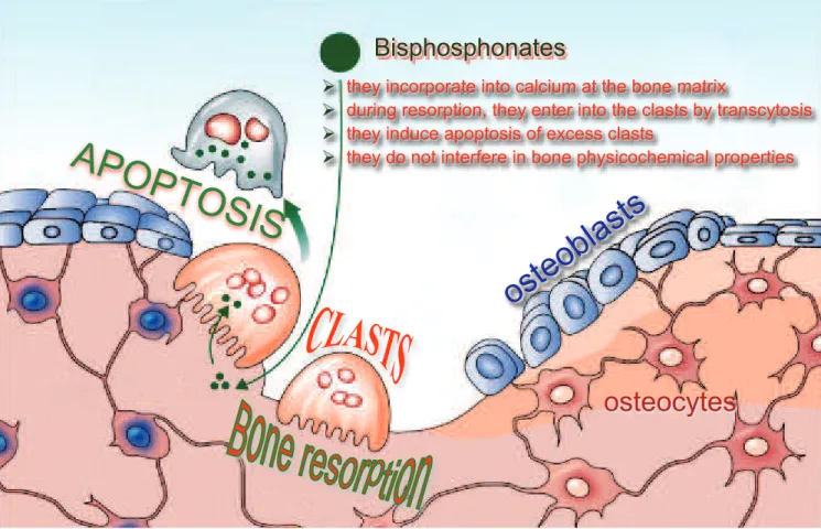 Figure 2. One of the mechanisms of action of bisphosphonates in controlling accelerated bone remodeling consists of controlling the number of clasts, thereby  inducing apoptosis when it enters into the medication molecule during bone remodeling caused by t