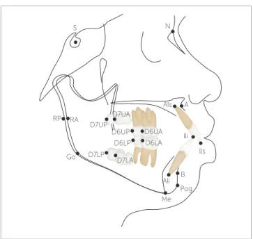 Figure 1 - Skeletal and dental cephalometric points. S (Sella), N (Nasion),  A (Subspinal), B (Supramental), Go (Gonial), Me (Mentalis), Pog (Pogonion),  IIs (Incisal edge of maxillary central incisor), AIs (Apex of upper incisor),  IIi (Incisal edge of th