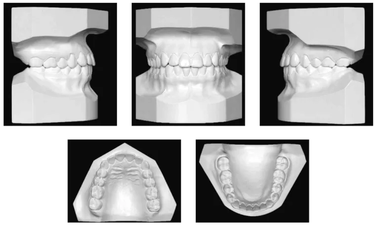 Figure 12 - Final dental casts.