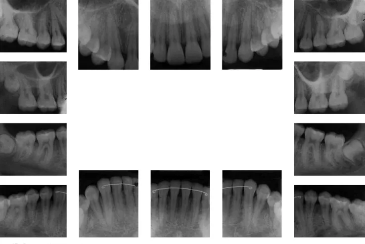 Figure 14 - Final profile cephalometric radiograph (A) and cephalometric tracing (B).