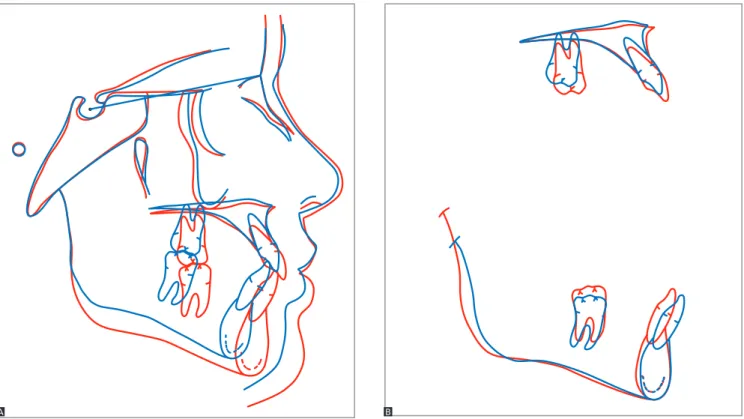 Figure 15 - Total (A) and partial (B) superimpositions of intermediate (blue) and final (red) cephalometric tracings.