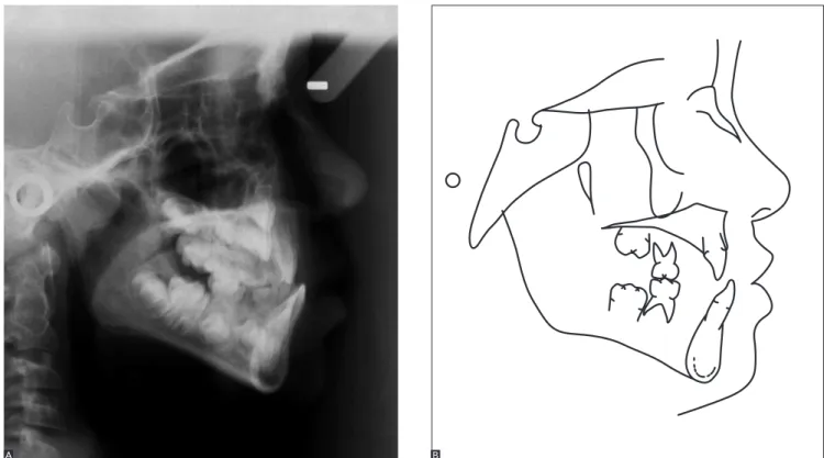 Figure 4 - Initial profile cephalometric radiograph (A) and cephalometric tracing (B).