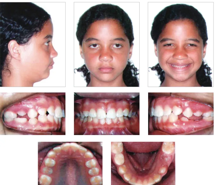 Figure 6 - Intermediate facial and intraoral photographs.