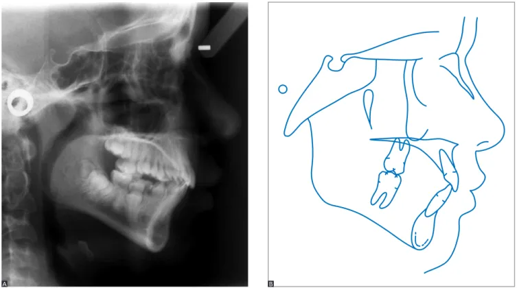 Figure 10 - Total (A) and partial (B) superimposition of initial (black) and intermediate (blue) cephalometric tracings.