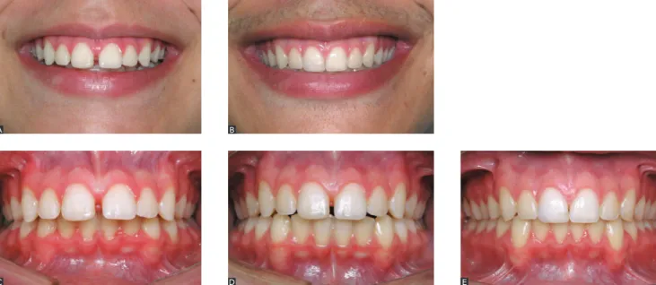 Figure 17 - Diastema correction in maxillary lateral  incisors area: A) initial frontal view; B) initial lateral  view of maxillary left incisor; C) final frontal view; 