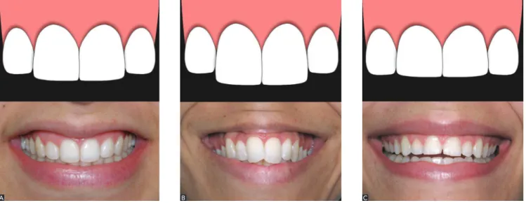 Figure 9 - Different width-height ratio of central incisors: A) ideal ratio, between 75 and 85%; B) long teeth with ratio < 75%; and C) short or squared teeth with  ratio > 85%.AA BB CC