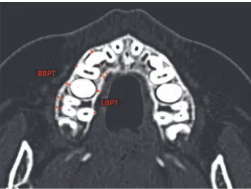 Figure 3 - Measurements of buccal and lingual bone plate thickness (BBPT  and LBPT) of deciduous posterior teeth were performed in the axial section,  parallel to the palatal plane, passing at the level of right maxillary deciduous  second molar furcation.