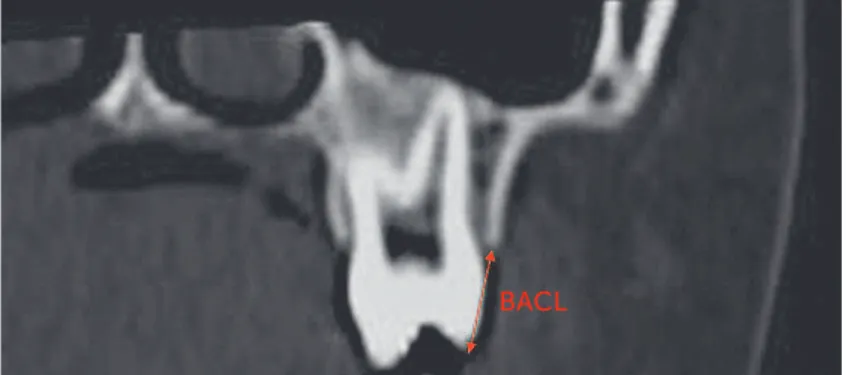 Table 2 shows that buccal bone plate thickness of sup- sup-porting teeth was not signiicantly changed by RME
