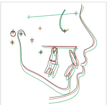 Figure 1 - Mean cephalometric landmarks in the three observation phases: 