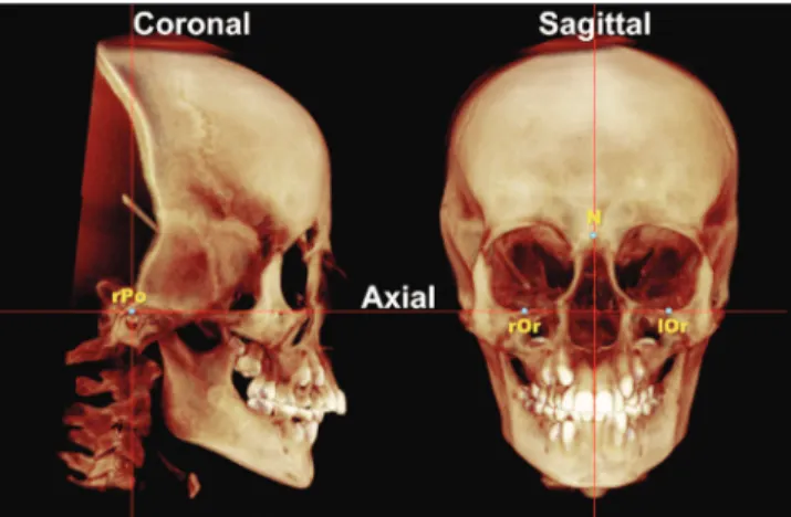 Figure 1 - 3D digital image of the head after orientation by axial, coronal and  sagittal planes used as references.