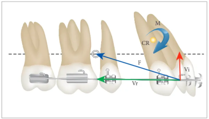 Figure 14 - Effect of force applied to the orthodontic archwire during sliding  mechanics associated with mini-implants