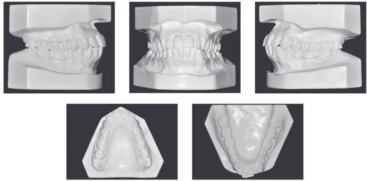 Figure 2 - Initial casts.