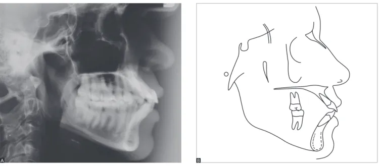 Figure 5 - Initial lateral cephalogram (A) and cephalometric tracing (B).
