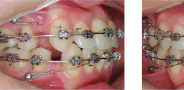 Figure 6 - Progress of the anterior retraction phase.