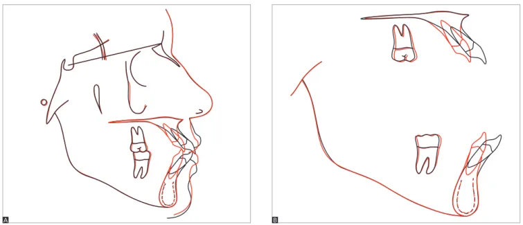 Figure 12 - Initial (black) and final (red) cephalometric tracing total (A) and partial (B) superimposition.